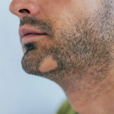 ¿Tu barba presenta calvas? Esto es lo que debes hacer para decirles adiós