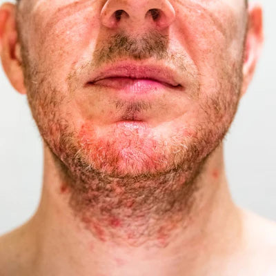 Cómo prevenir la foliculitis de la barba: consejos para un rostro saludable
